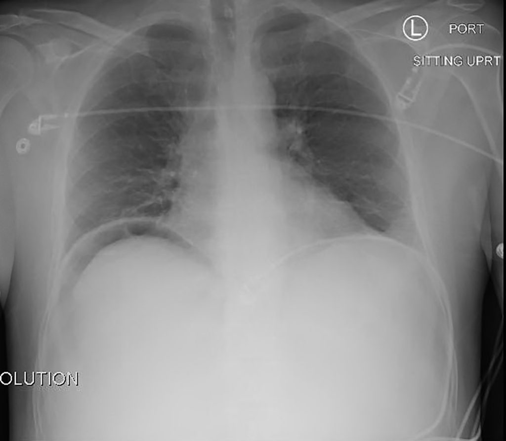 Perforated Ulcer AP CXR JETem 2016 JETem