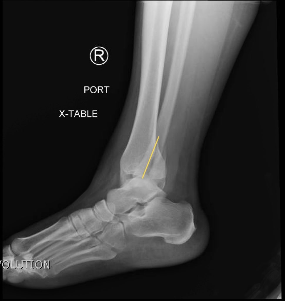 Trimalleolar Fracture Lateral XRay Annotated JETem 2016 JETem