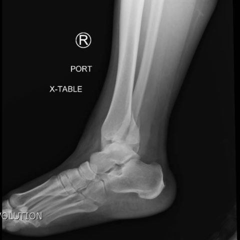 Trimalleolar Fracture Jetem