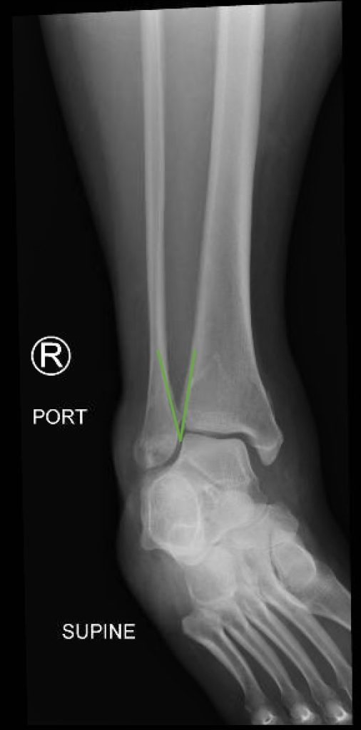 Trimalleolar Fracture Oblique XRay Annotated JETem 2016 JETem