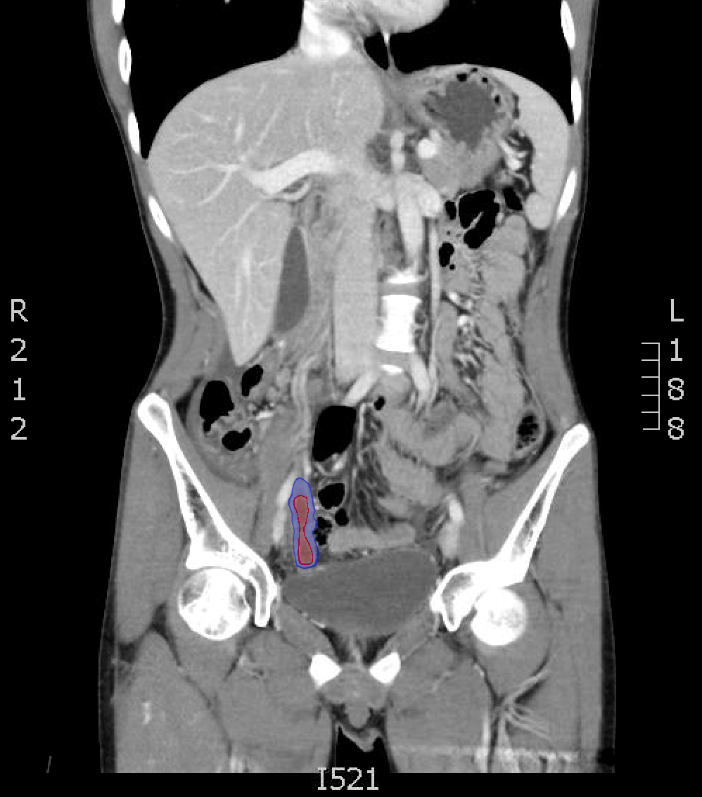 CT Diagnosis Of Appendicitis JETem