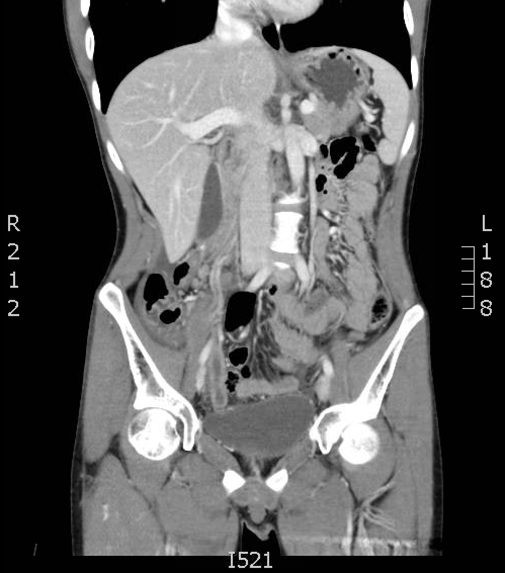 CT Diagnosis Of Appendicitis JETem