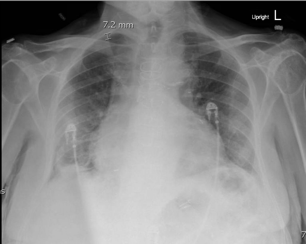 Reexpansion Pulmonary Edema Cxr Jetem Jetem