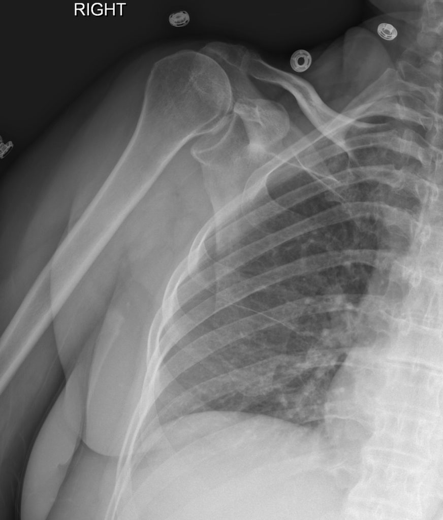 Anterior Shoulder Dislocation Post Reduction Ap Xray Unannotated