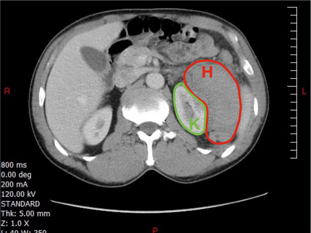 FAST Exam To Diagnose Subcapsular Renal Hematoma JETem