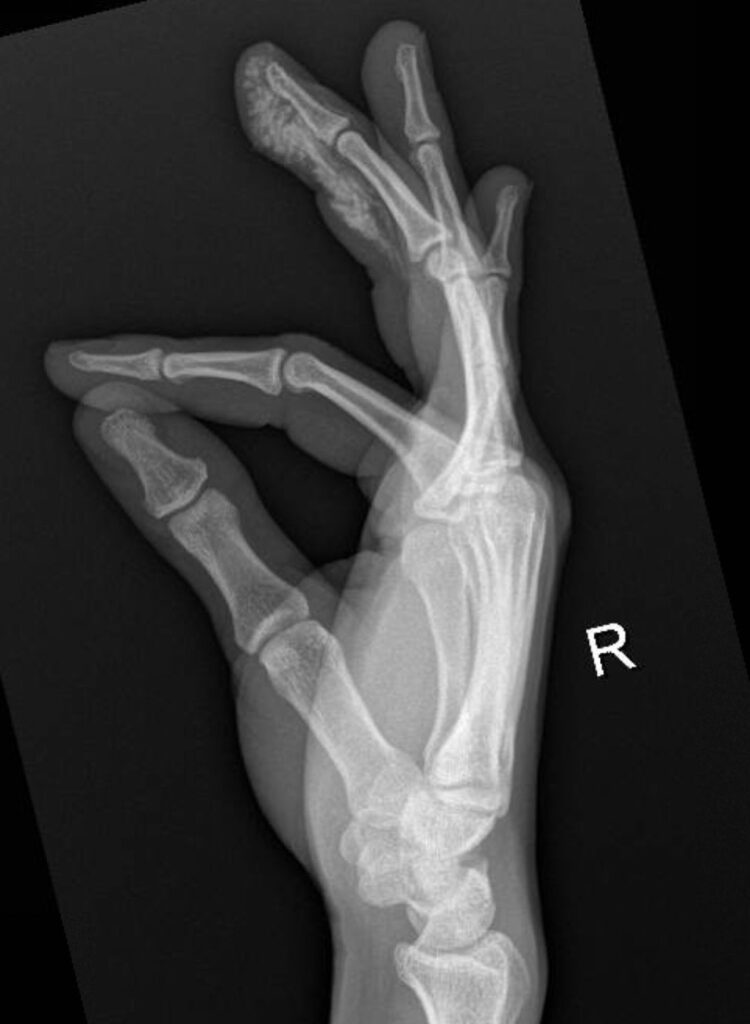 High Pressure Hand Injection Injury Lateral Xray Unannotated Jetem