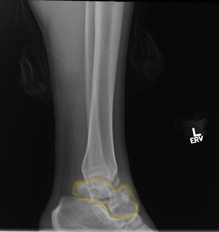 Talar Neck Fracture Lateral Xray Annotated Jetem Jetem