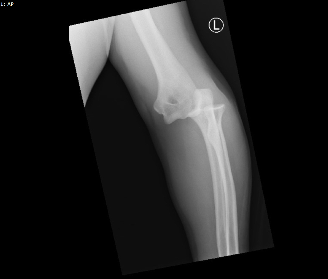 Druj Elbow Xray Ap Unannotated Jetem Jetem