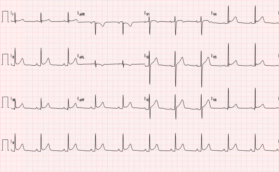  Electrocardiogram