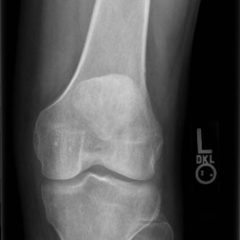 Normal Knee X-Ray: 3 View - JETem