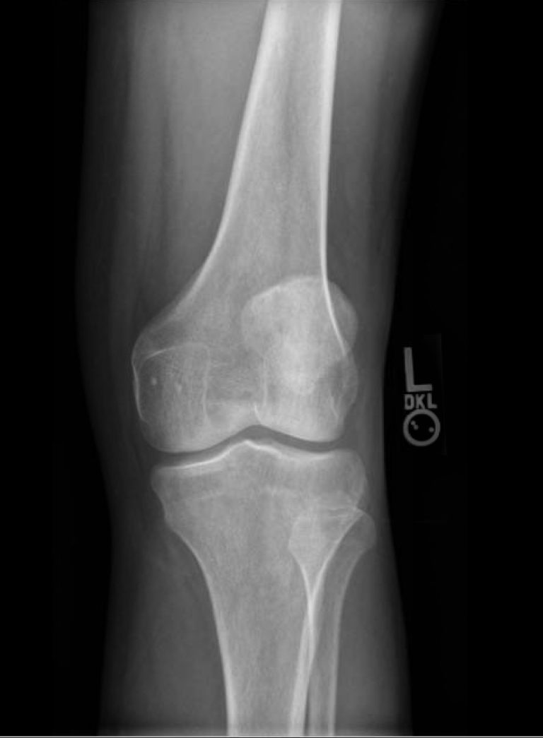 Knee XR Oblique - JETem