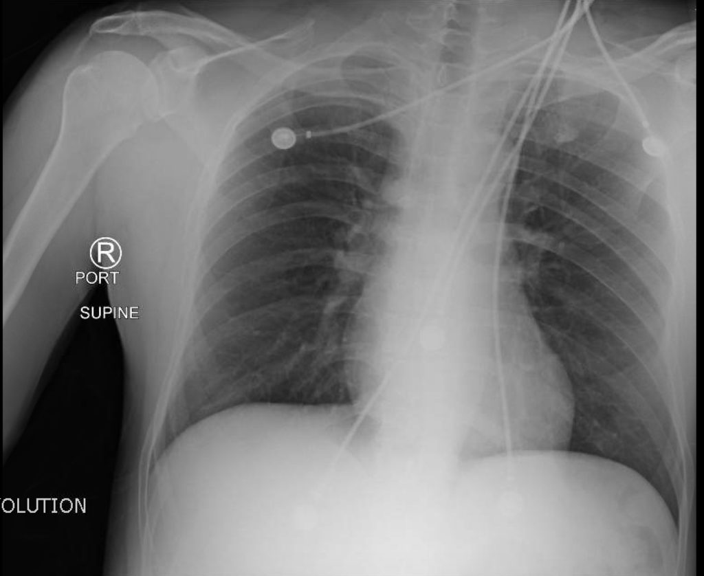 Normal CXR - JETem