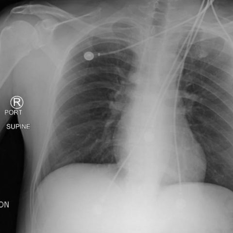 Normal Cxr And Post-intubation Cxr - Jetem