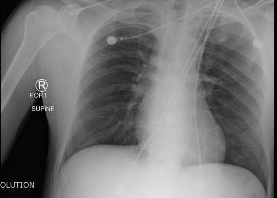 Normal chest x-ray