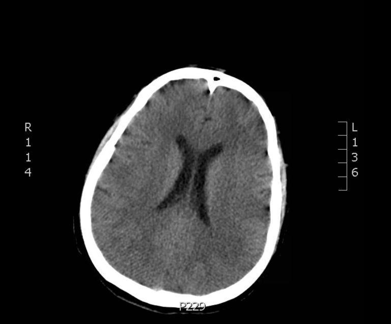 Normal head CT 6 - JETem