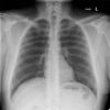 Normal CXR and Post-Intubation CXR - JETem