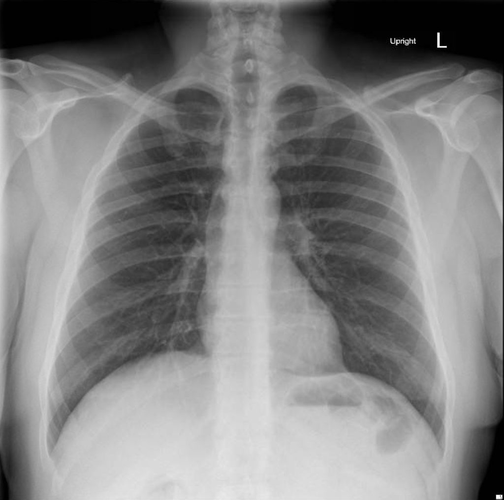 Normal CXR: AP and Lateral - JETem