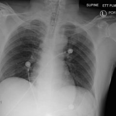 post intubation chest x-ray