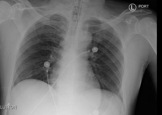 post intubation chest x-ray
