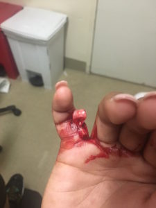 5th Finger Dislocation Photograph JETem 2016