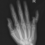 5th Finger Dislocation Xray JETem 2016