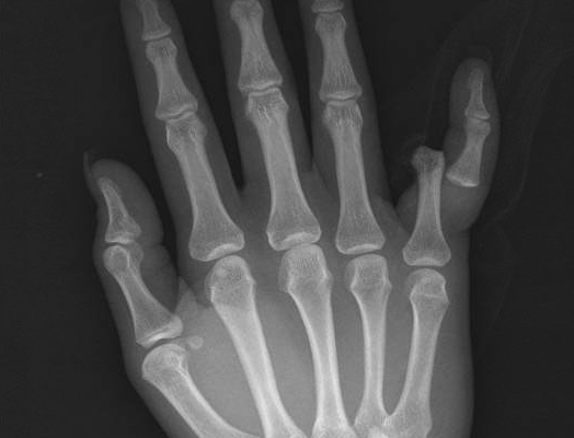 5th Finger Dislocation Xray JETem 2016