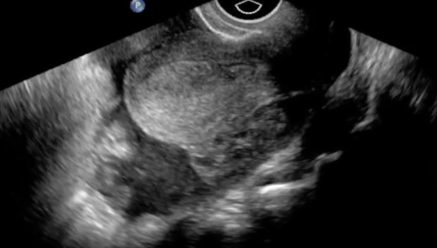 ruptured ectopic pregnancy ultrasound