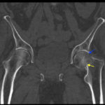 Femoral Neck Fracture, AP CT, Annotated. JETem 2016