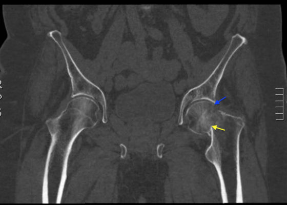 Femoral Neck Fracture, AP CT, Annotated. JETem 2016