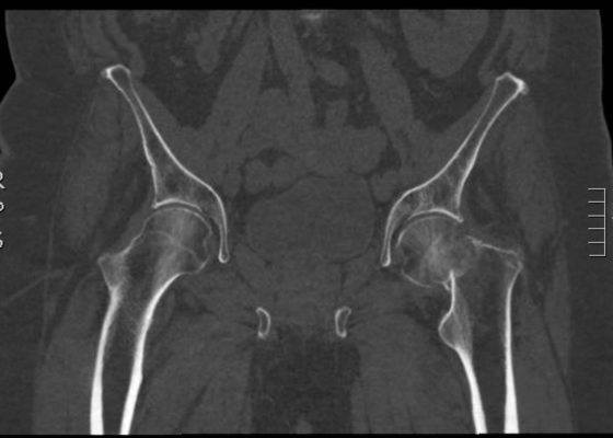 Femoral Neck Fracture, AP CT. JETem 2016