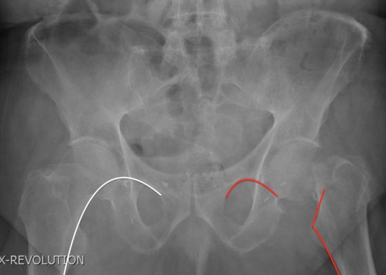 Femoral Neck Fracture, AP Xray, Annotated. JETem 2016