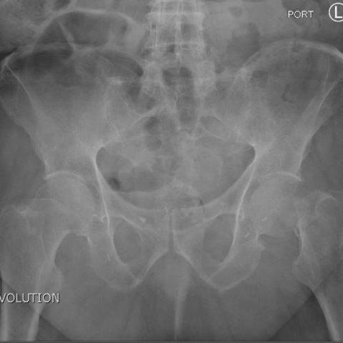 Femoral Neck Fracture - JETem