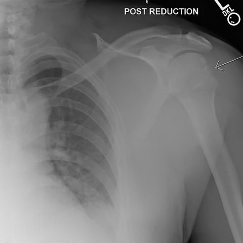 Hill-Sachs Deformity - JETem