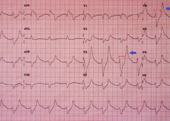 Hyperkalemia ECG, Annotated. JETem 2016