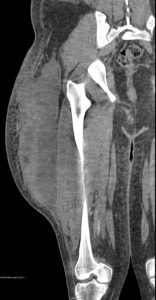 Morel Lavalee Lesion