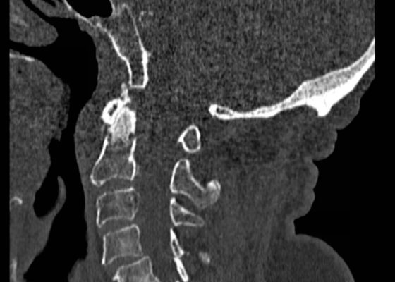 Odontoid Fracture, CT Sagittal. JETem 2016