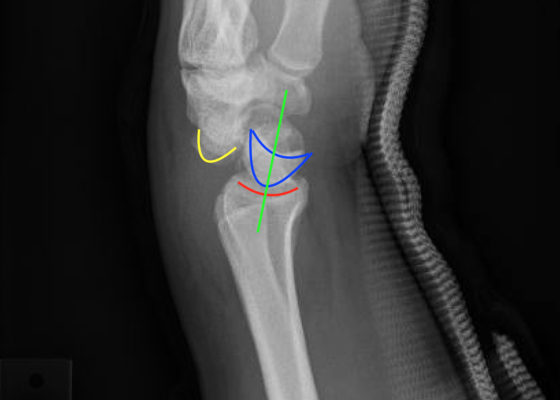 Perilunate Dislocation, Xray, Annotated. JETem 2016