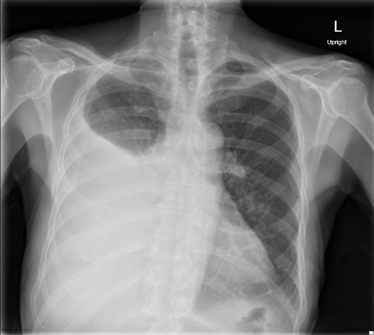 Pleural Effusion, AP Chest Xray JETem 2016 - JETem