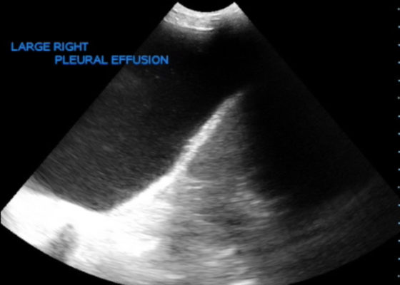 Large Right Pleural Effusion