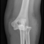 Posterior Elbow Dislocation, AP XRay, dislocated. JETem 2016