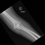 Posterior Elbow Dislocation, AP XRay, reduced. JETem 2016