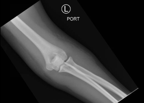 Posterior Elbow Dislocation, AP XRay, reduced. JETem 2016