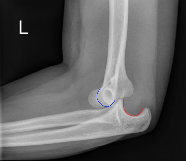 Posterior Elbow Dislocation, Lateral XRay, dislocated, Annotated. JETem ...