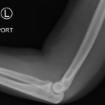 Posterior Elbow Dislocation, Lateral XRay, reduced. JETem 2016