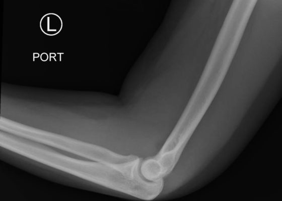 Posterior Elbow Dislocation, Lateral XRay, reduced. JETem 2016