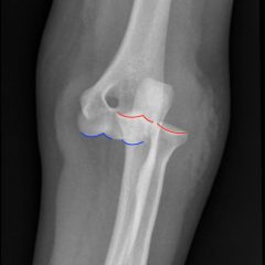 Posterior Elbow Dislocation - JETem