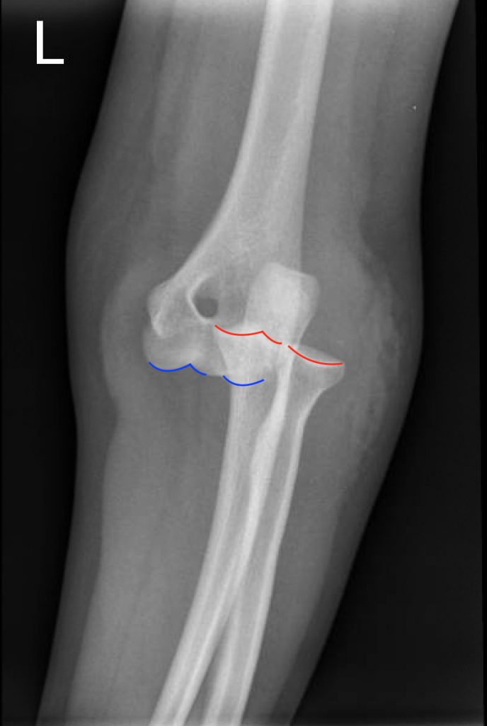 Posterior Elbow Dislocation, Oblique XRay, dislocated, Annotated. JETem 2016 JETem