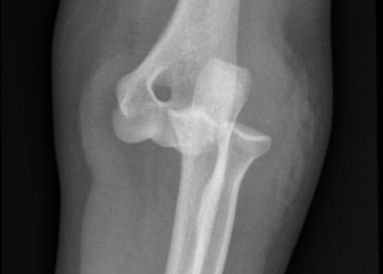 Posterior Elbow Dislocation, Oblique XRay, dislocated. JETem 2016