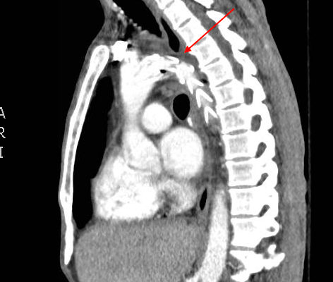 Traumatic Aortic Injury. Sag CT 1, Annotated. JETem 2016