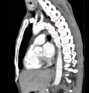 Traumatic Aortic Injury. Sag CT 2 Annotated. JETem 2016